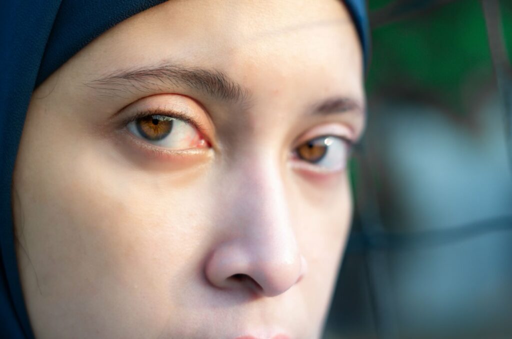 A close up of a woman's eyes. The further away eye is slightly out of focus to signify "blurry vision".