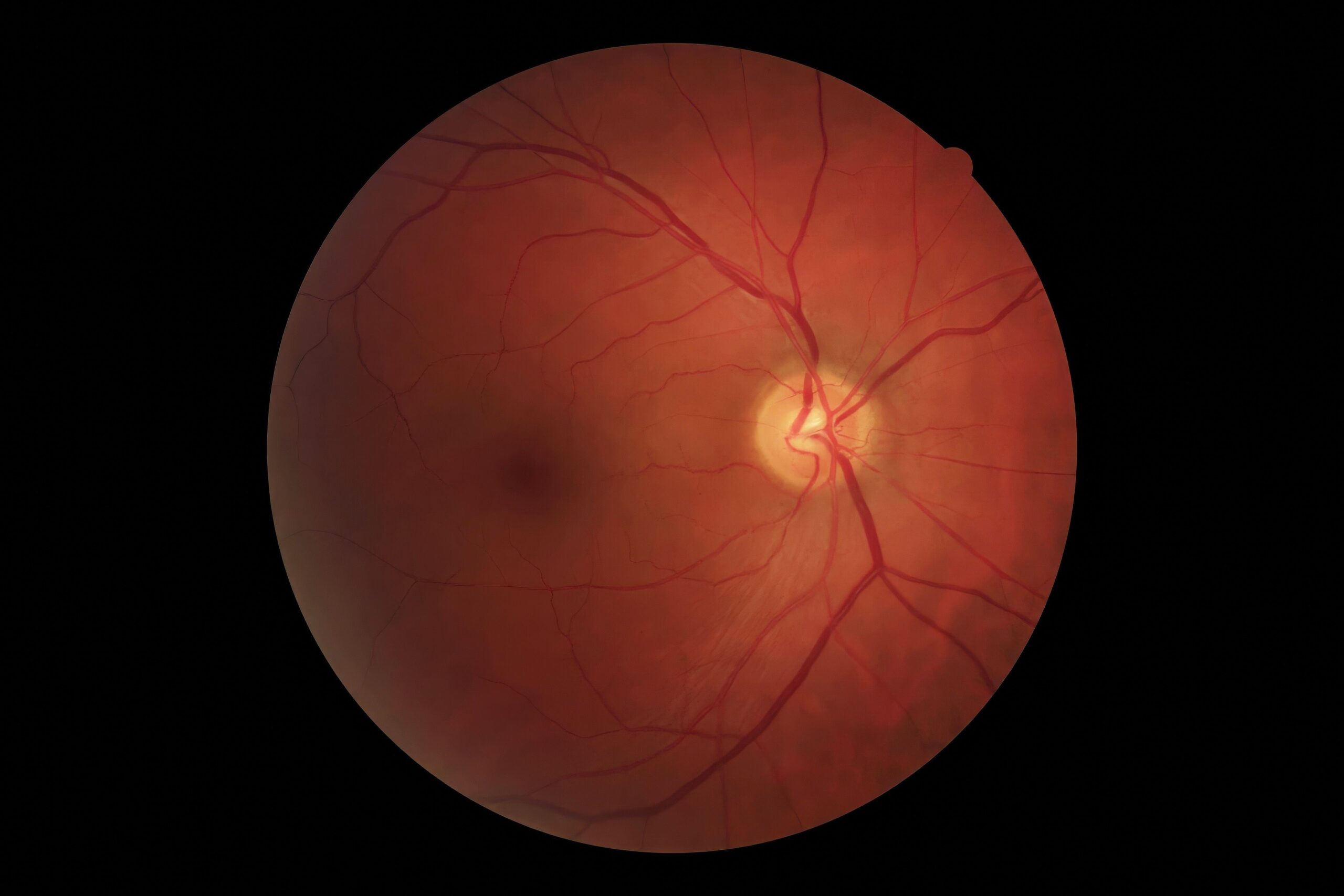 A detailed digital retinal scan showing the optic nerve and blood vessels, used in eye exams to detect signs of eye disease and overall health issues.